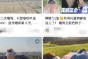 曬背養生火了 醫生提醒過度曬背可能造成曬傷